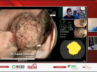 endoscopia-ai-inteligencia-artificial-400x300